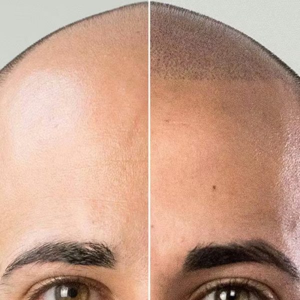 9-scalp-micropigmentation-smp-skinreal – μεγάλη